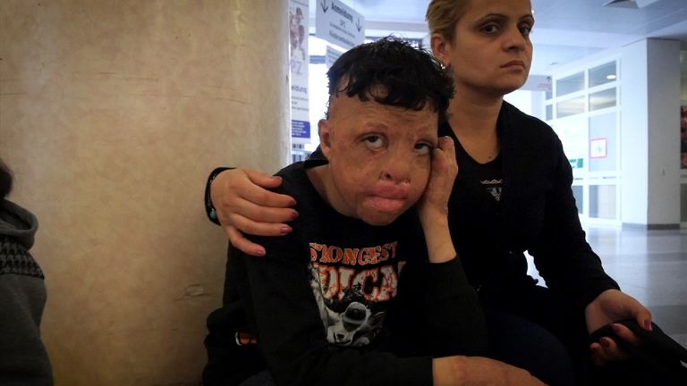 Syrian children who have been injured face a long road to recovery even after they have fled the country&#39;s civil war
