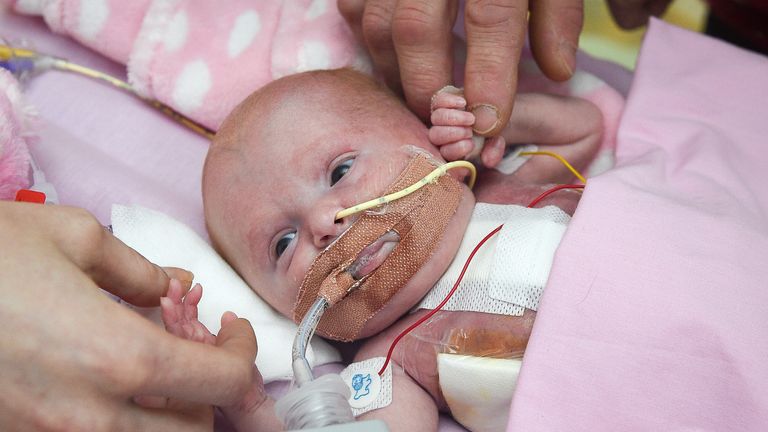 Vanellope Wilkins at three weeks old after undergoing several operations to enclose her heart