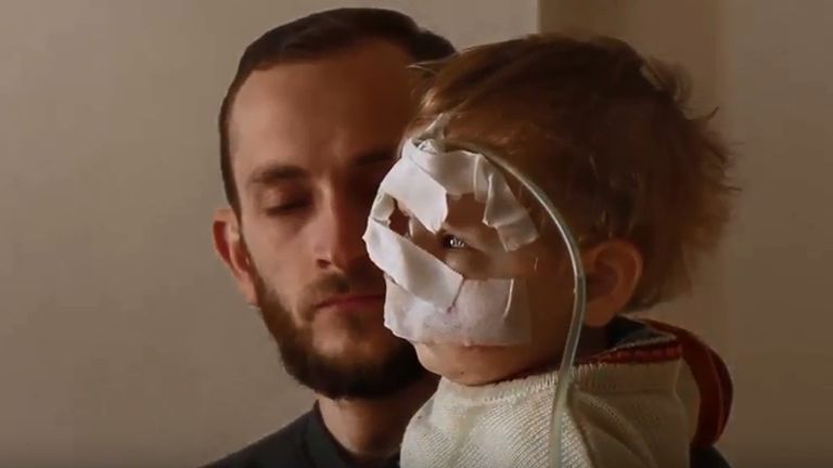 Qasem, who lost his mother and suffered disfigurement to his face in a bombardment in Ghouta last year