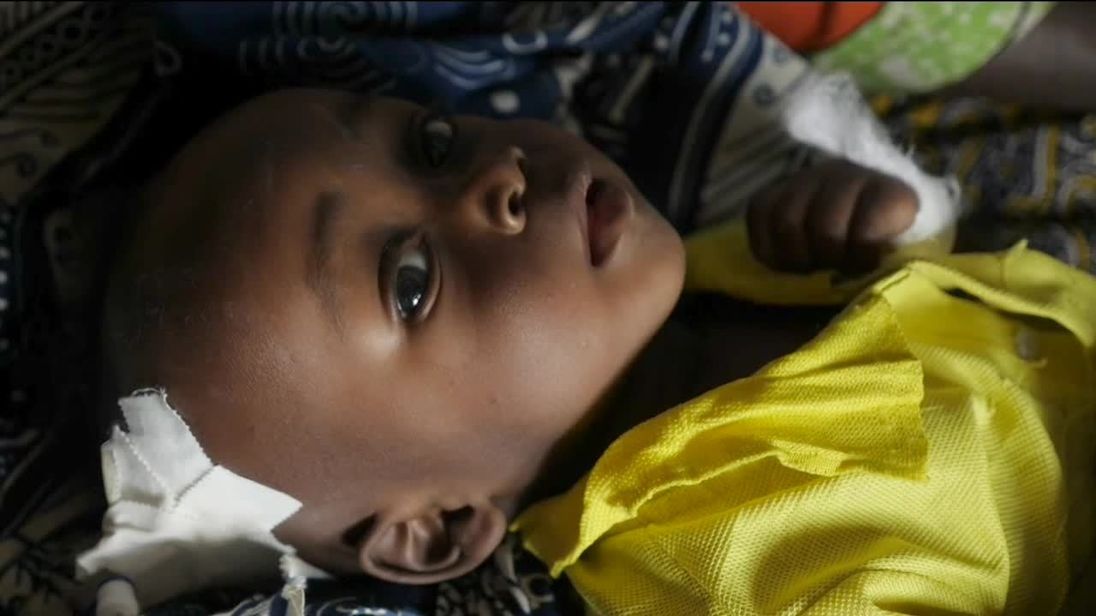 A severely malnourished child in the Democratic Republic of Congo