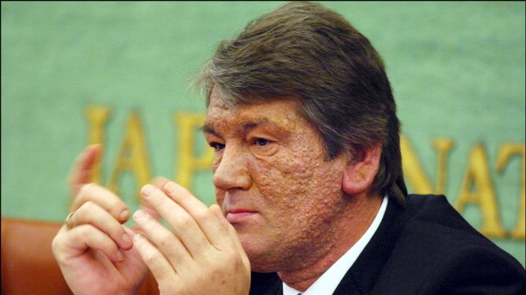 Viktor Yuschenko&#39;s face was covered in skin growths after he was poisoned in 2004