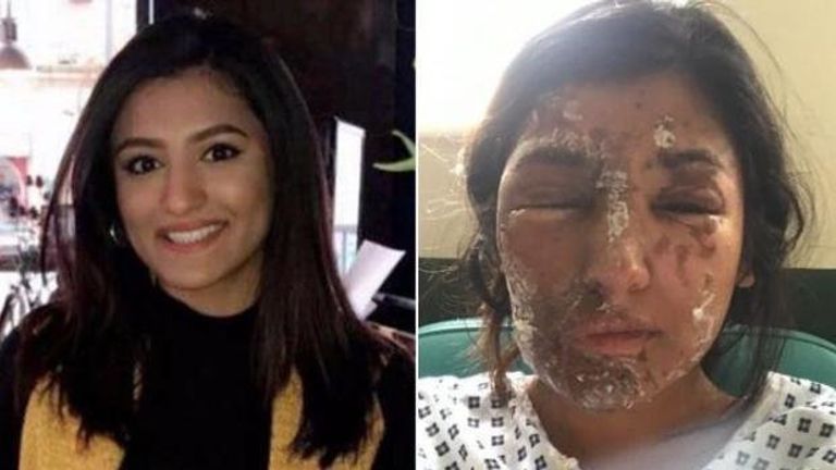 Resham Khan was attacked with acid after celebrating her 21st birthday in June 2017. Pic: change.org