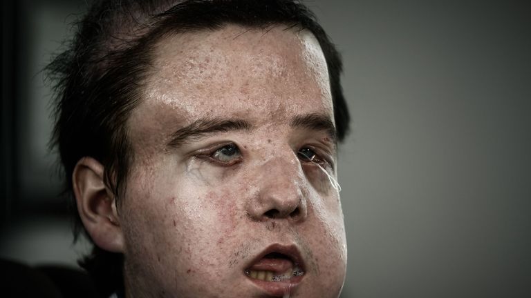 Jerome Hamon is the first man to undergo a face transplant twice
