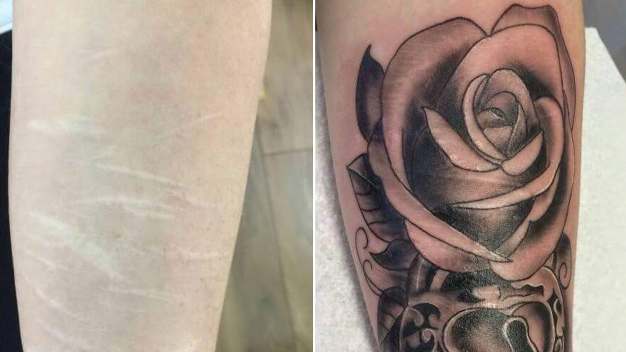 I was considering covering self harm scars with a tattoo, does this work  and does further self harm cause gaps in the ink? - Quora