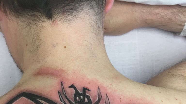 Martin had a bee tattooed on his back while in hospital