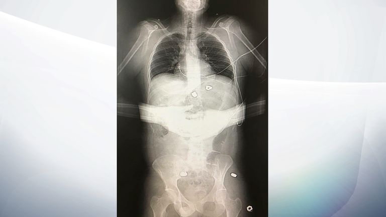 X-ray showing five of the 22 bolts in Martin's torso
