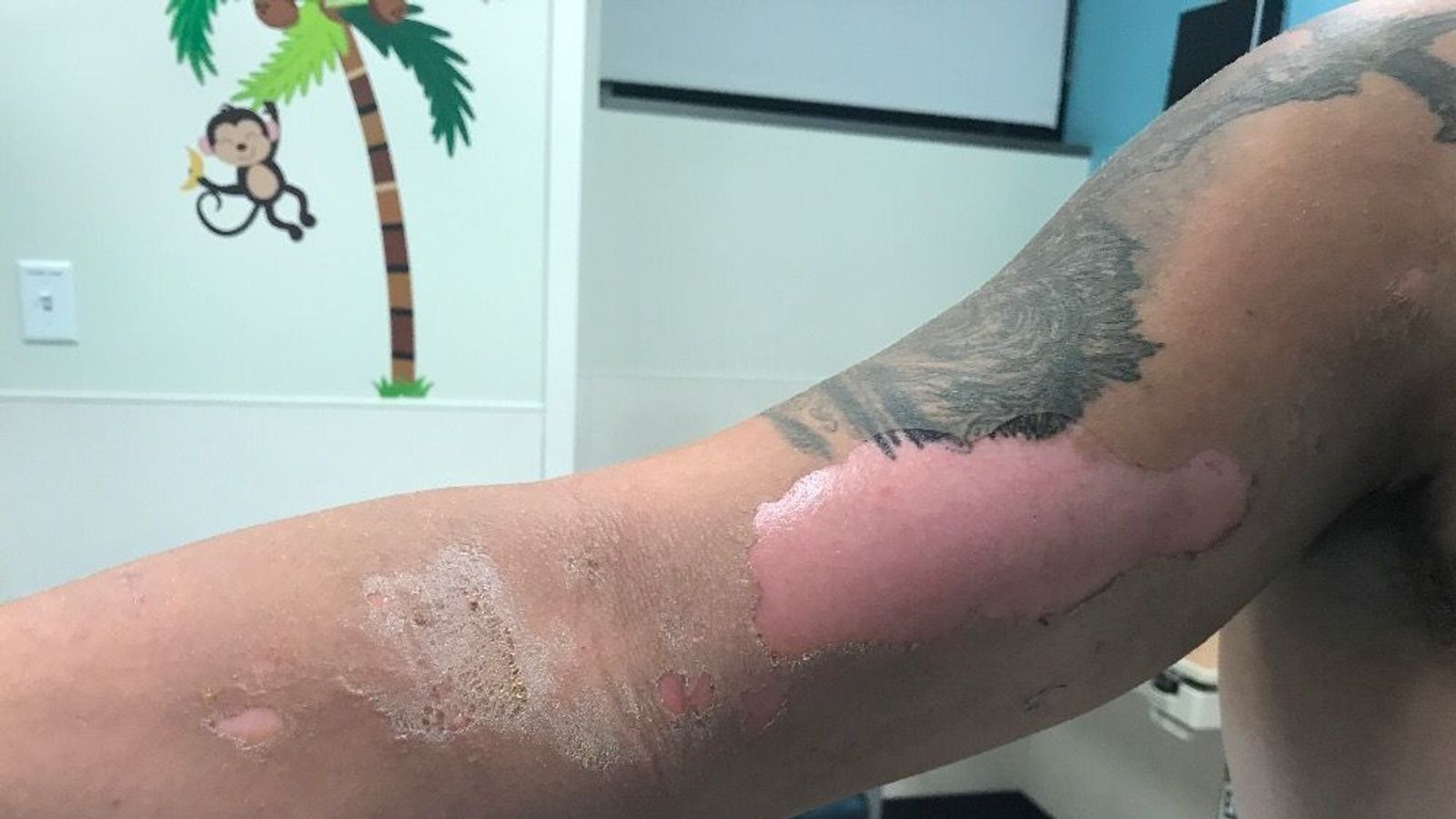 Teenager suffers serious burns after coming into contact with toxic plant Offbeat News Sky News