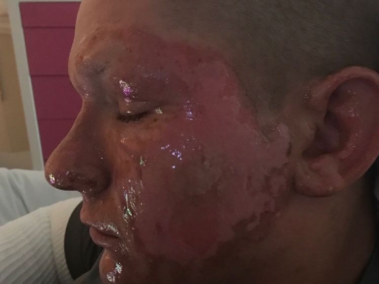 The teenager suffered serious burns to his face and arm. Pic: GoFundMe/Alex Childress
