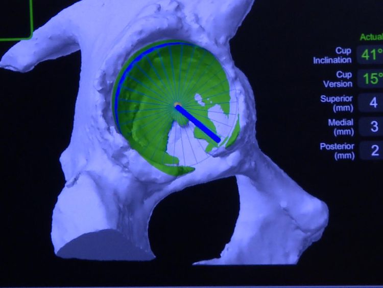 Surgeons use software to make sure Mako is in the right place