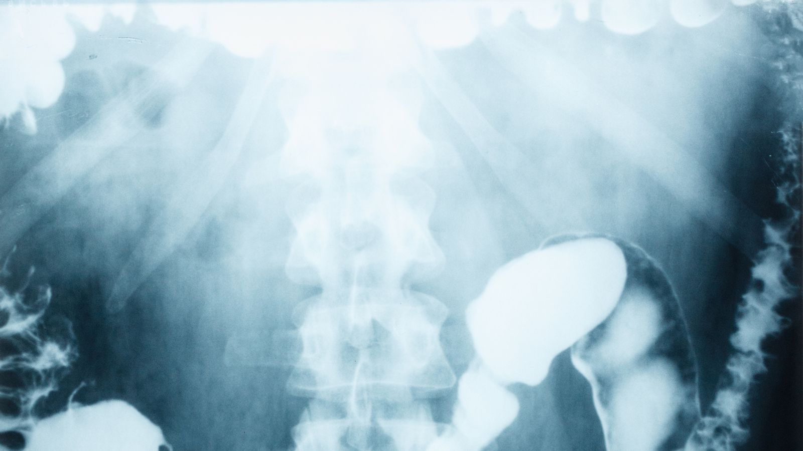 Bowel cancer screening age to be lowered to 50 in England