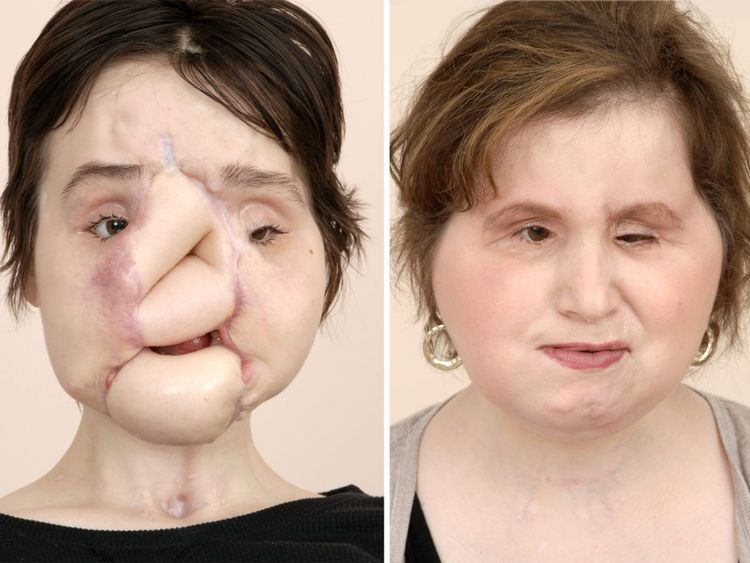 Ms Stubblefield underwent several surgeries before her transplant  Pic: Cleveland Clinic