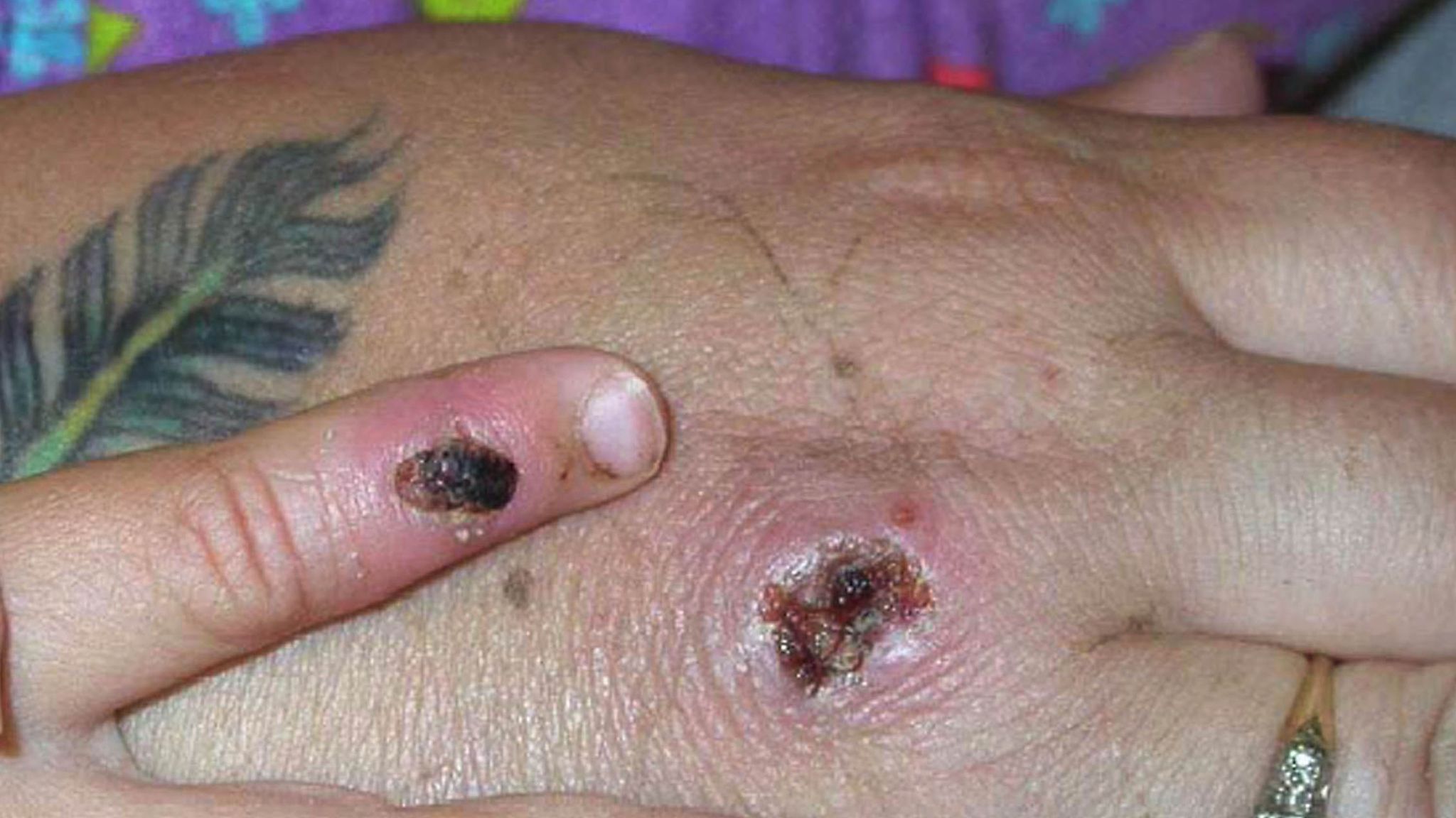 Monkeypox Uk - Monkeypox virus: Infection spread in UK by clothes and