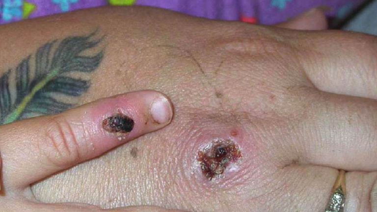 Monkeypox Symptoms : Monkey Pox - Causes, Symptoms, Treatment