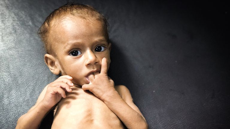 Nusair, a victim of malnutrition helped by Save The Children