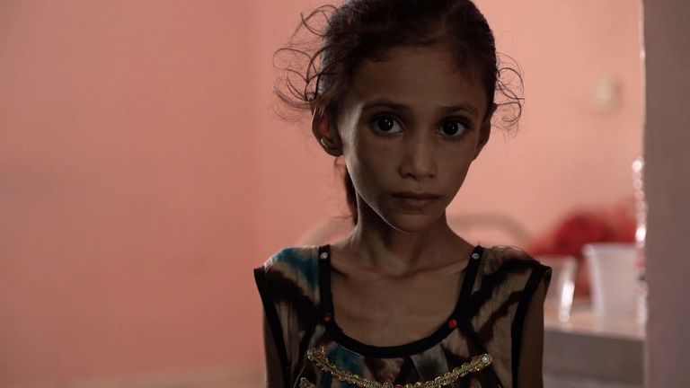 Anissa Abdulmoniem is suffering from severe malnutrition 