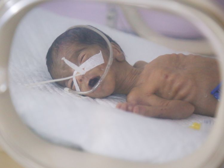 Half of Yemeni children under the age of 5 are chronically malnourished. This baby is being treated at Al Thawra hospital. Pic: Unicef