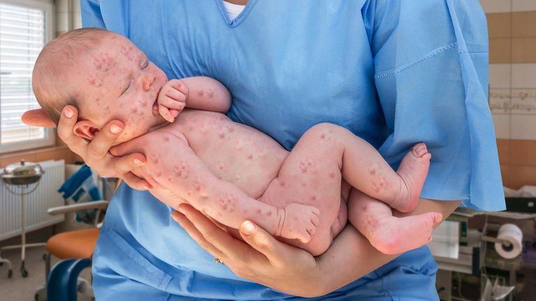 Baby with measles. File pic