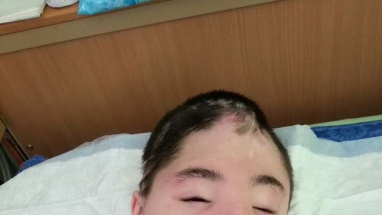 Vanya Krapivin, 16, lost most of his frontal skull bone in the attack