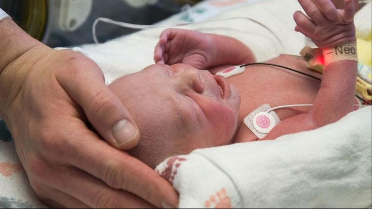 Baby is born after womb transplant from dead donor