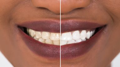 Superdrug teeth whitening kits