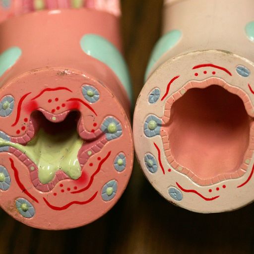 Leicester scientists trial new asthma pill which could reduce attacks