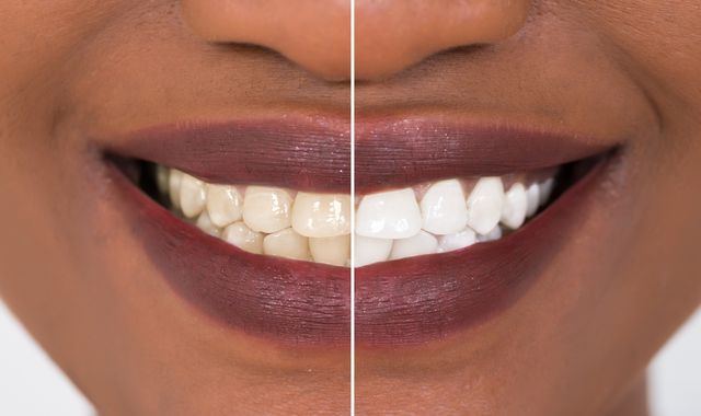Consumers 'gambling with their teeth' by using whitening kits Consumers 'gambling with their teeth' by using whitening kits