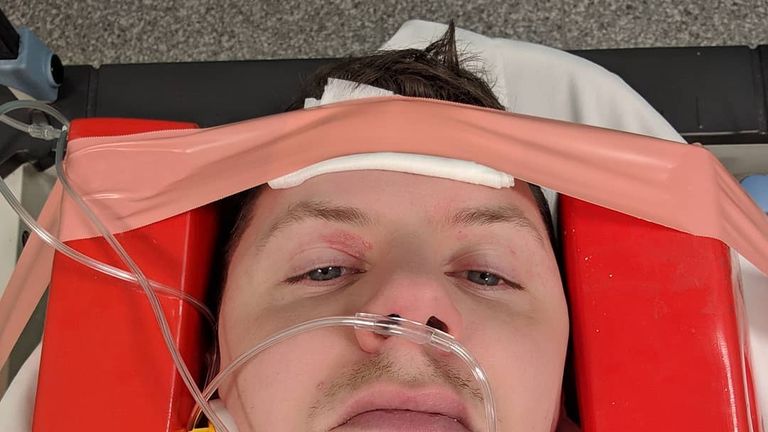 Professor Green had to cancel his tour after the fracture