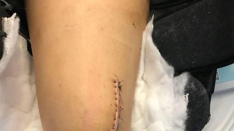 Ms Bates' leg after her surgery