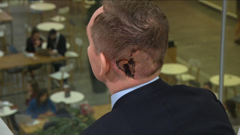 Chris Bryant MP reveals the scars from his skin cancer