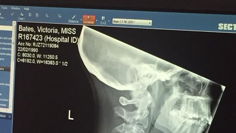 Miss Bates now has a metal plate in her neck