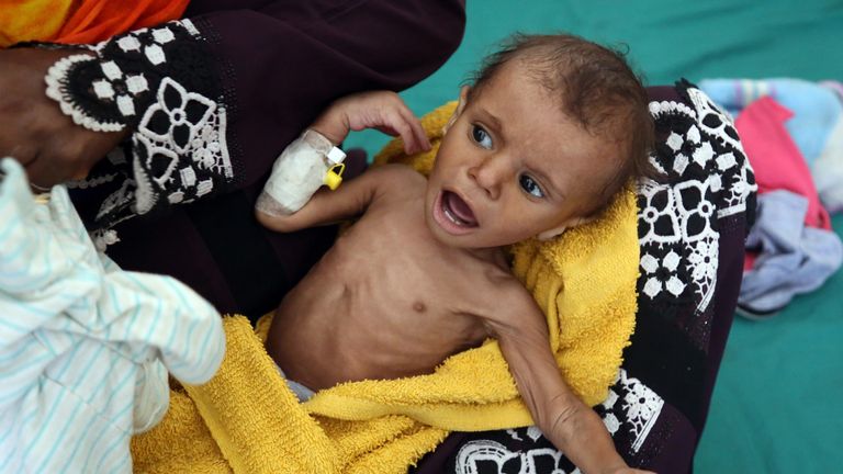 Yemeni child suffers from malnutrition 