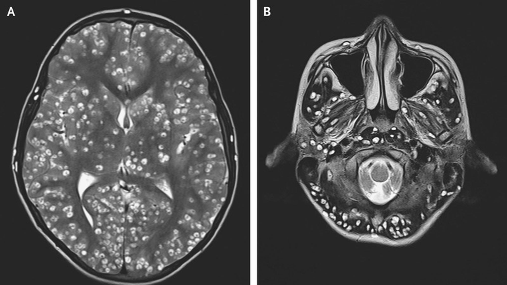 Man, 18, tapeworm larvae in his brain after eating pork | World News | Sky News