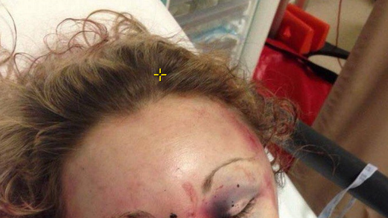 Ms Dronfield was left with a swollen face, bleed on the brain and a stab wound among other injuries