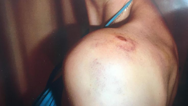 Natasha shared images of some of the injuries she suffered while in private care