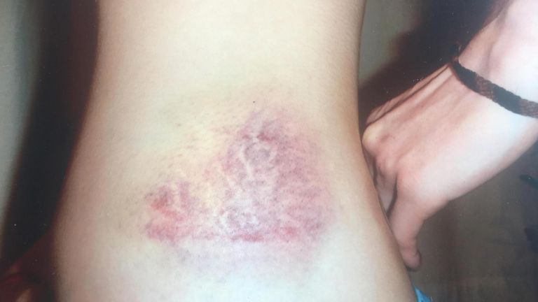 An image shows an injury Natasha suffered while in care 