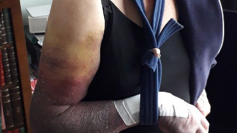 The woman's arm was broken and she needed stitches on her hand