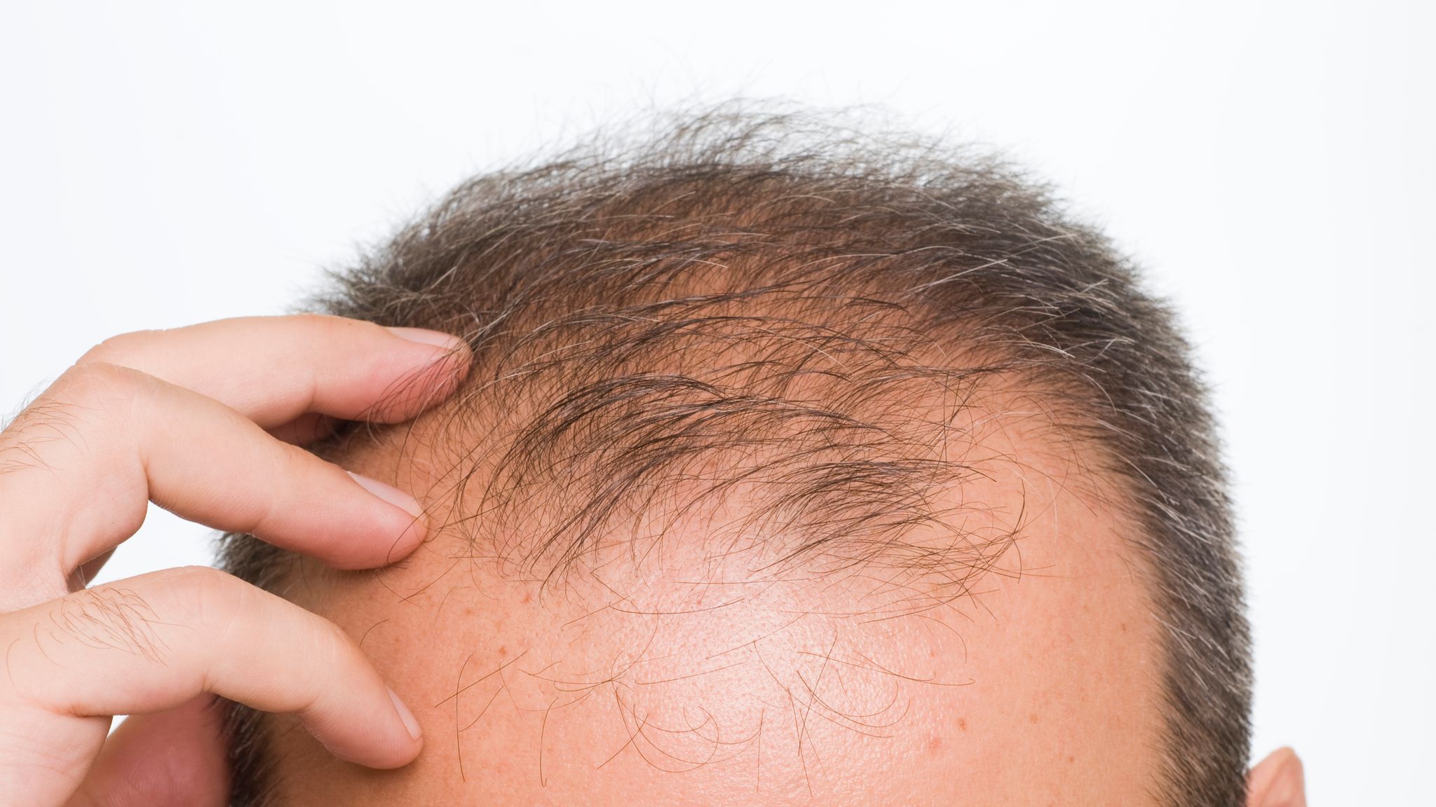 Baldness solution 'breakthrough' discovered by scientists | US News | Sky  News