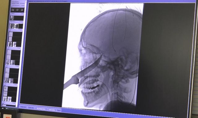 Teenager survives after 10in blade narrowly misses his brain