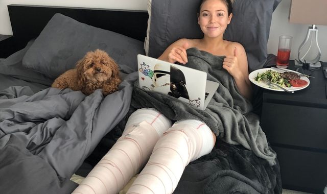 Model suffers horrific burns after 'reckless' photoshoot stunt
