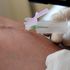 Blood test could detect breast cancer five years before clinical signs