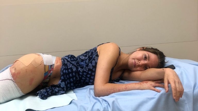 Robyn Lee has suffered burns to her legs, hips, back and right arm. Pic: GoFundMe