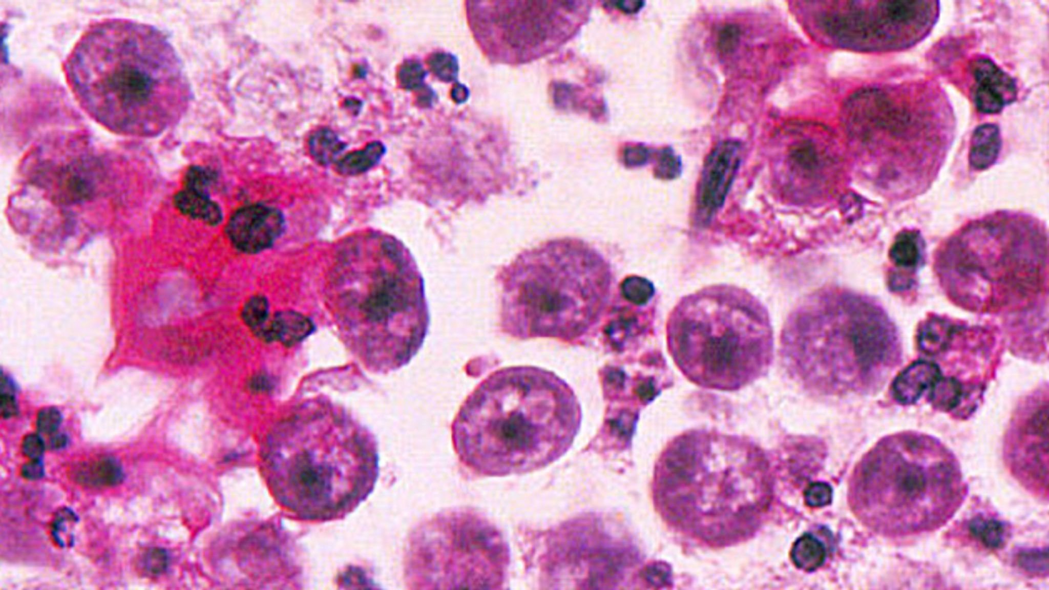 Rare 'brain-eating' Amoeba Infects Person In Florida, Health Officials ...