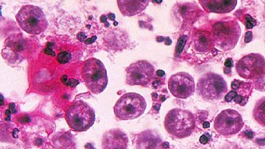 Swimmer dies after being attacked by rare brain-eating amoeba | US News