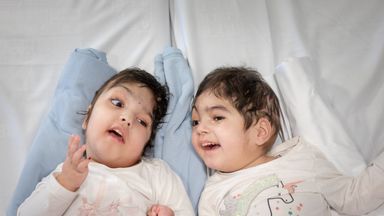 conjoined marwa safa separated ormond ullah surgeons mchugh underwent