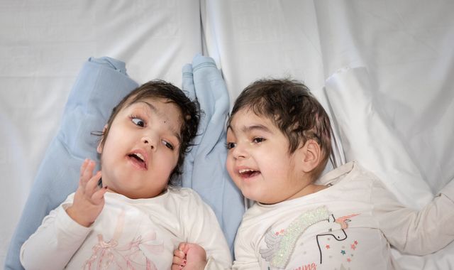 Surgeons who separated conjoined twins launch charity to fund similar operations