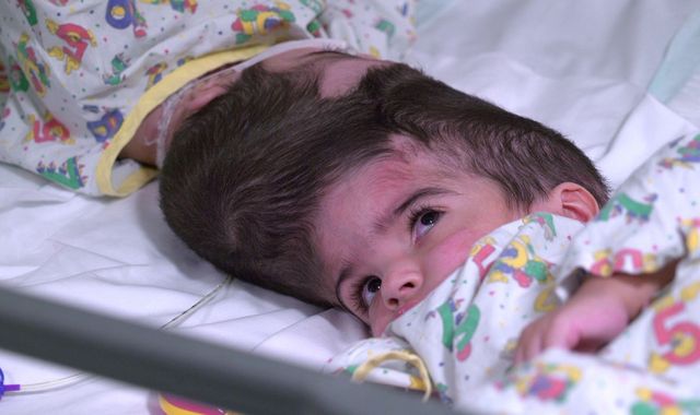 Twins conjoined by skulls separated after 50 hours of operations