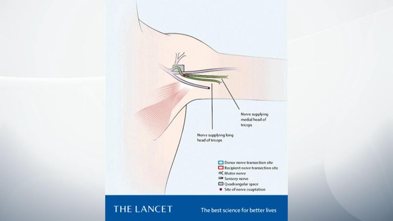The working nerves were able to 'reanimate' the previously paralysed muscle. Pic: The Lancet