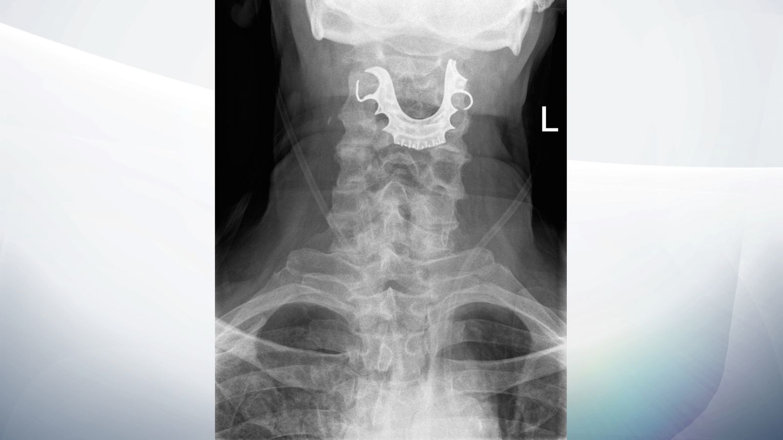 Pensioner spent eight days with his false teeth stuck in his throat