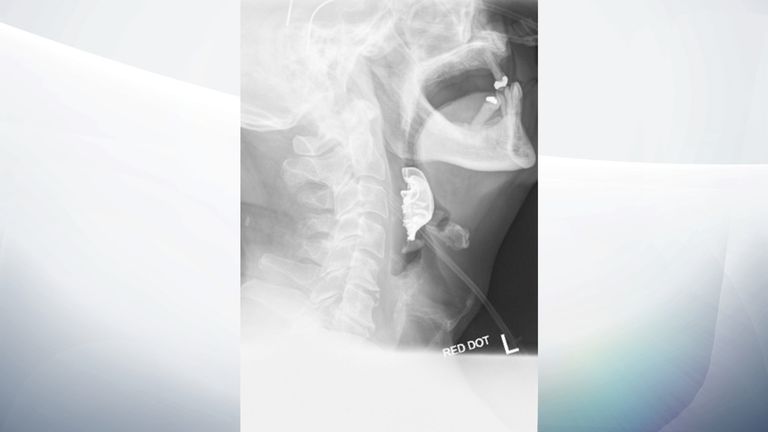 An X-ray of the dentures stuck in the pensioner's throat. Pic: BMJ/PA Wire