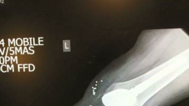 An x-ray of her knee after reconstructive surgery. Pic: Rachel Williams